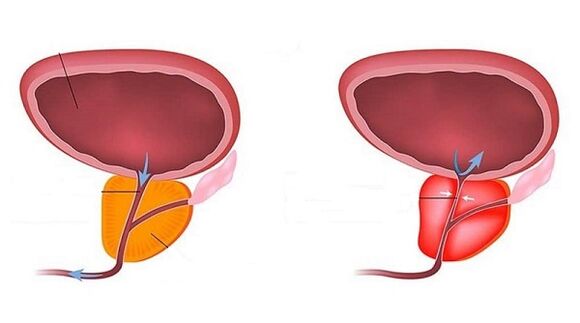 prostata sana e infiammata con prostatite